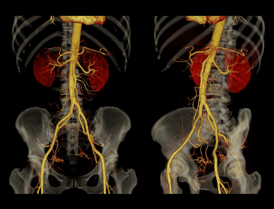 Aorta CTA